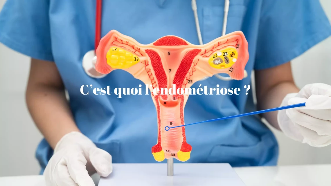 Mes réponses à ce que c'est l'endométriose