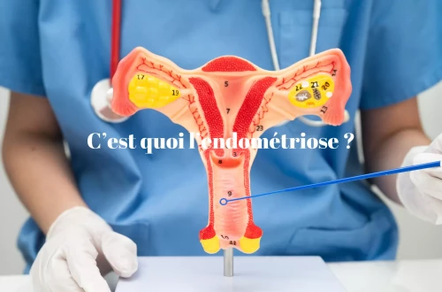Mes réponses à ce que c'est l'endométriose